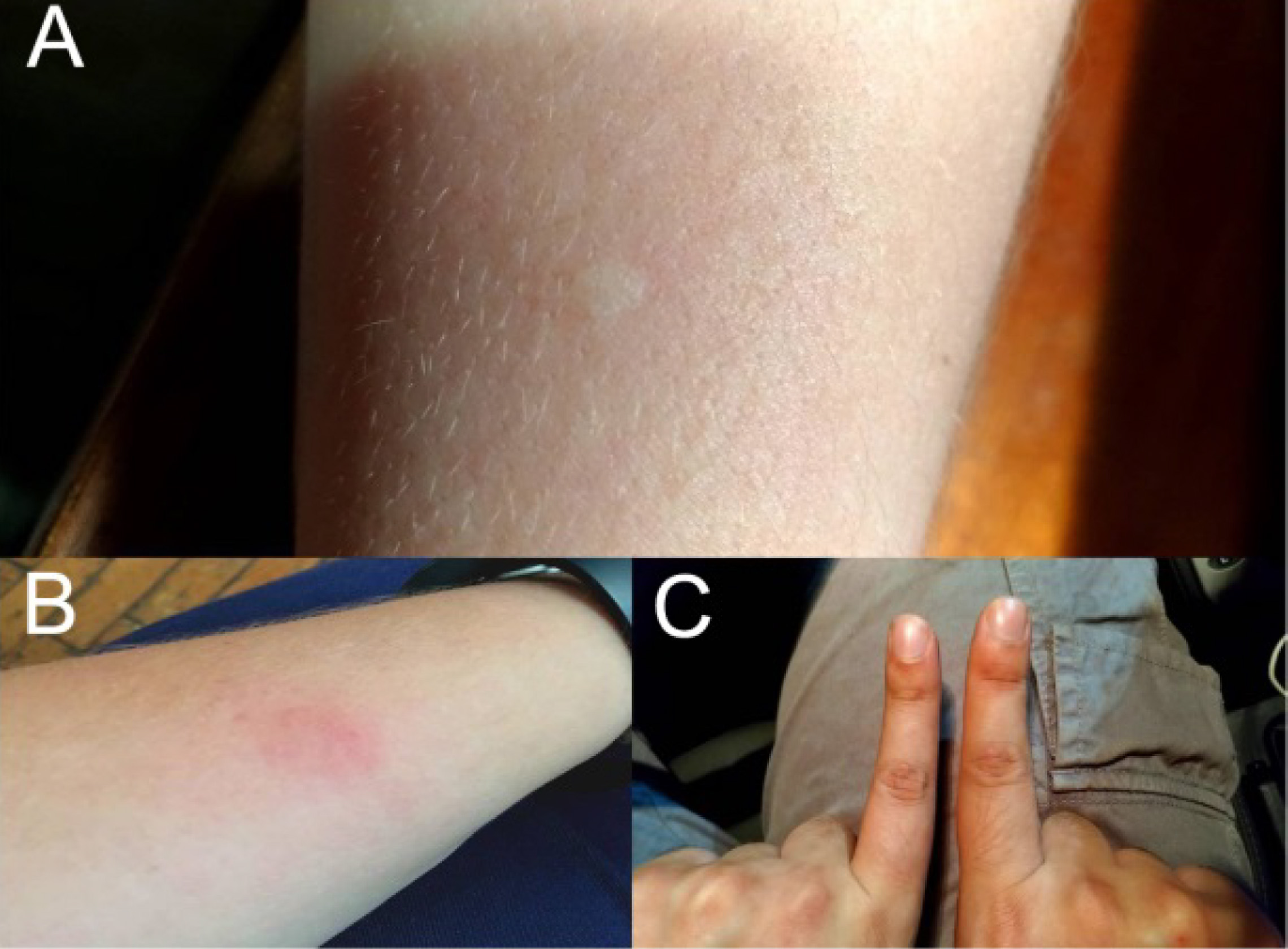 Tres fotografías muestran inflamación y enrojecimiento después de picaduras de Onychocerus albitarsis.