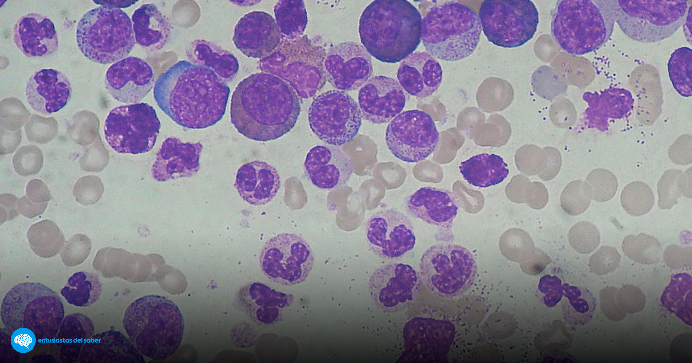 Leucemia tratamiento CAR-T
